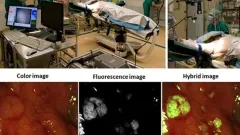 First clinical translation of fluorescent probes First clinical translation of fluorescent probes