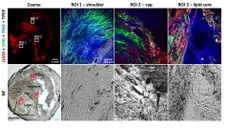 Multimodal optoacoustic and multiphoton microscopy (MPOM) of human carotid atheroma. Multimodal optoacoustic and multiphoton microscopy (MPOM) of human carotid atheroma.