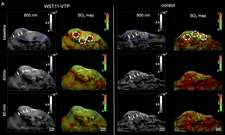 Tumors are depicted by MSOT