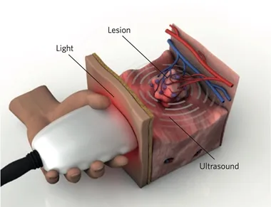 Example of a handheld MSOT device developed for skin imaging. Example of a handheld MSOT device developed for skin imaging.